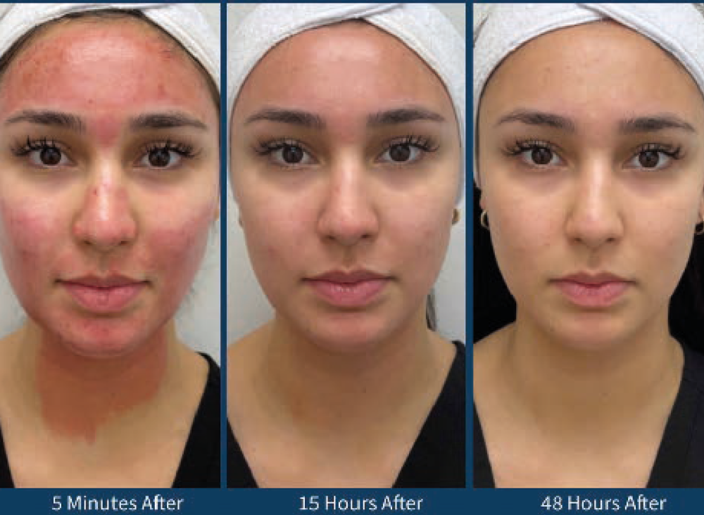 Microneedling