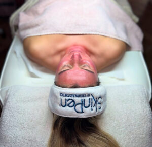 Microneedling
